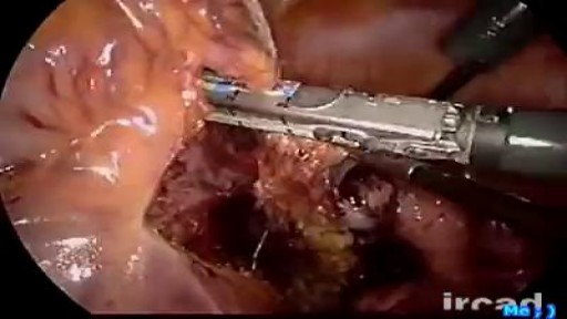 Bleeding control during laparoscopic pelvic surgery