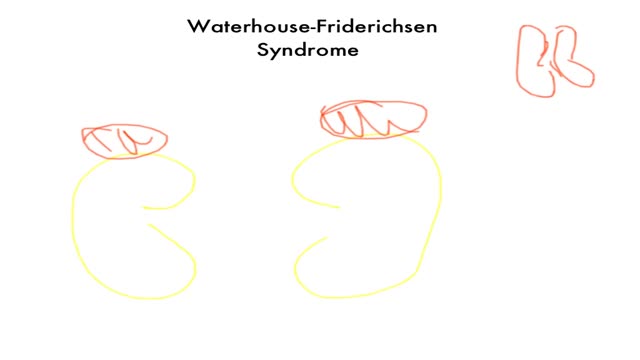 Waterhouse-Friderichsen Syndrome