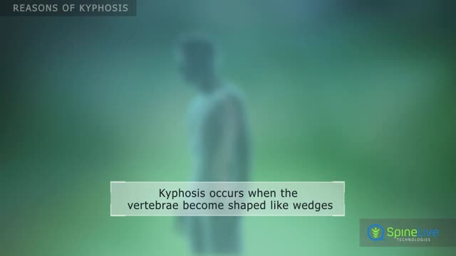 ⁣Kyphosis Reasons