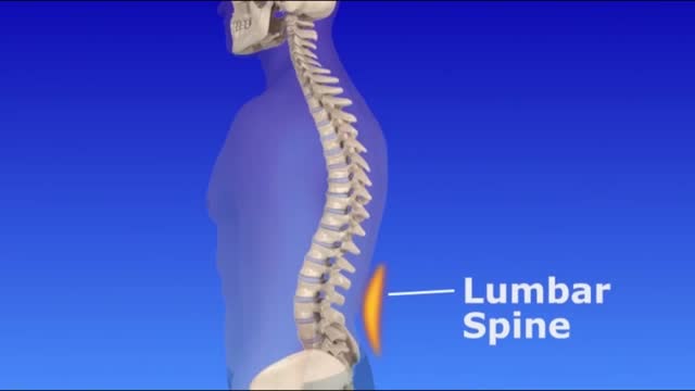 Scoliosis