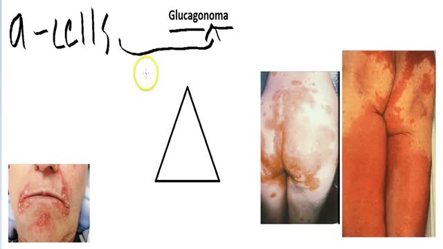 Glucagonoma