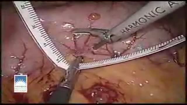 ⁣Laparoscopic Sleeve Gastrectomy Operation