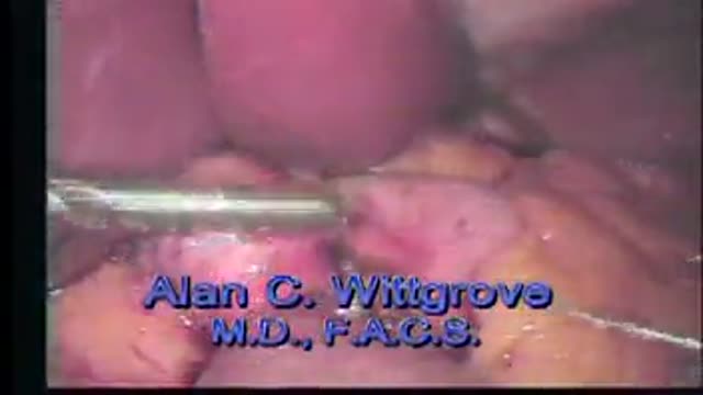 quick-stitch endoscopic sutering system in laproscopic Gastric Bypass surgery