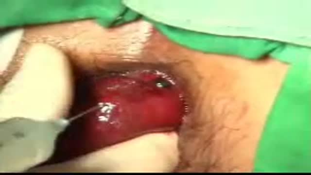 Stapled hemorrhoidectomy for acute hemorrhoidal crisis