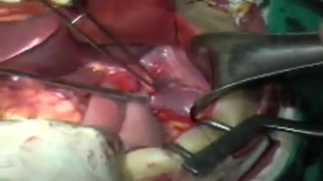 Anchoring suture of esophagojejunostomy after total gastrectomy