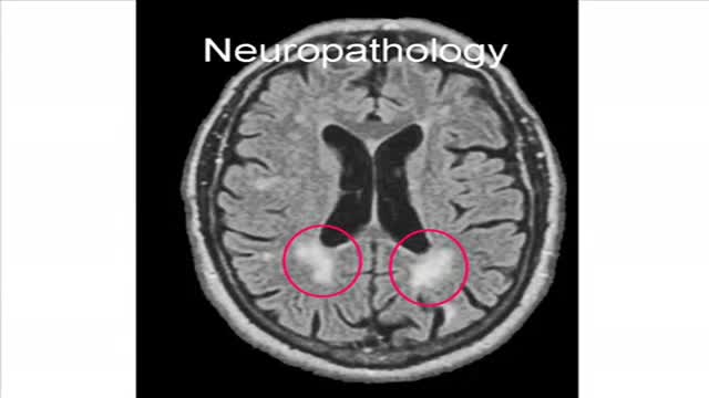 Binswanger's Disease