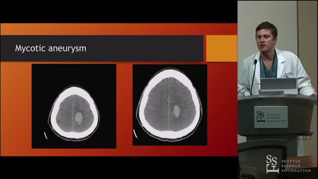 Mycotic aneurysms