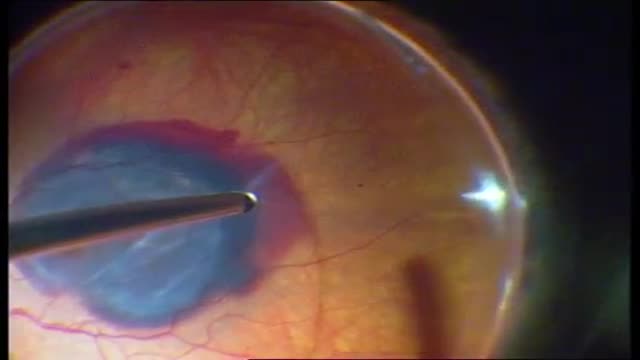 Macular translocation