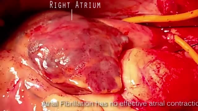 ⁣Atrial fibrillation vs Atrial Flutter