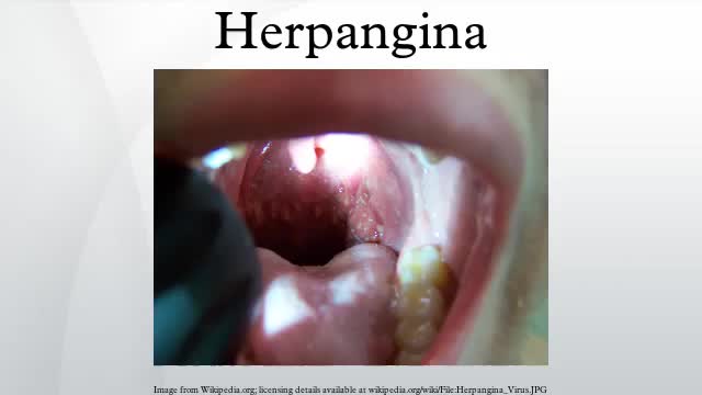 Herpangina