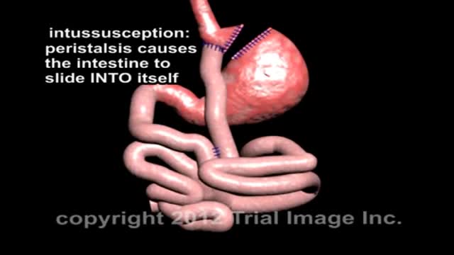 ⁣Intussusception of the Bowel video - Animation by Cal Shipley, M.D.