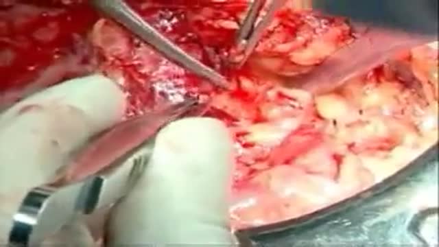 Whipple procedure