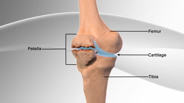 Patella Fracture Repair