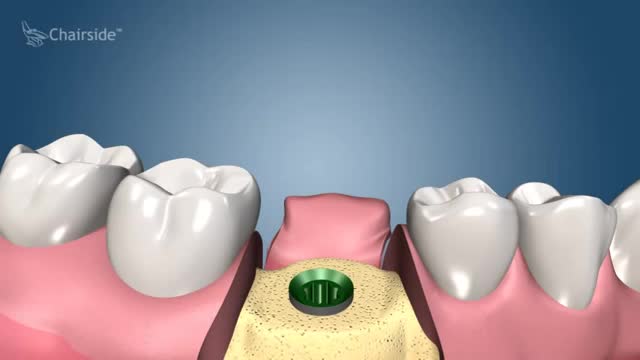 Dental Implant Procedure