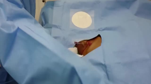 ⁣Tunneled Dialysis Catheter Insertion