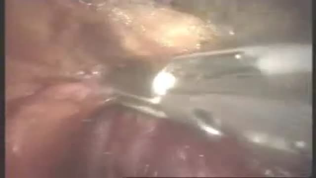 Splenectomy