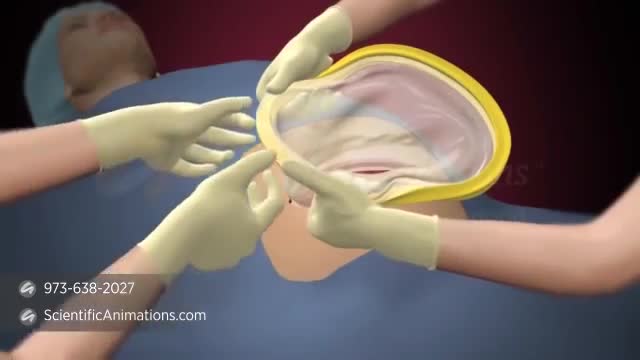 Gynecology 3D Animation