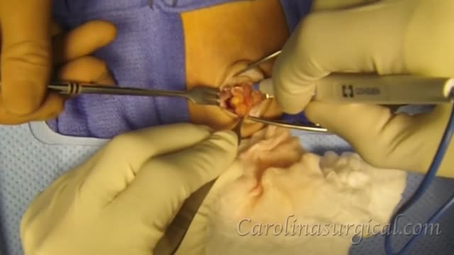 Hernia repair surgery