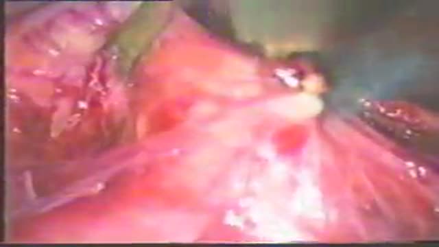 Esophagomyotomy for Achalasia