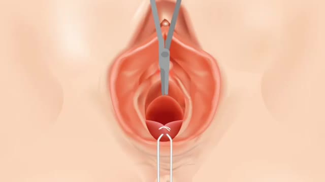 ⁣vaginal repair surgery