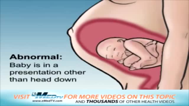 ⁣Abnormal Fetal Presentation