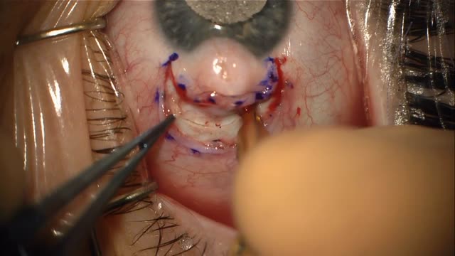 Limbal Dermoid Removal