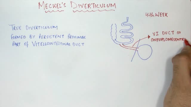 ⁣Meckel's Diverticulum