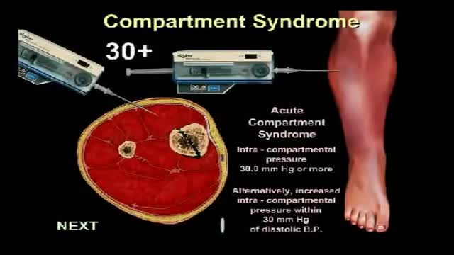 Compartment Syndrome