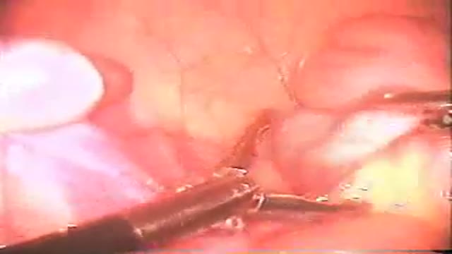 Laparoscopic Appendicectomy