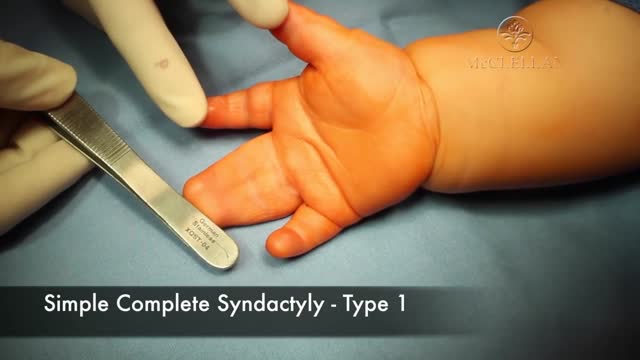 Syndactyly (Webbing) Release of Fingers