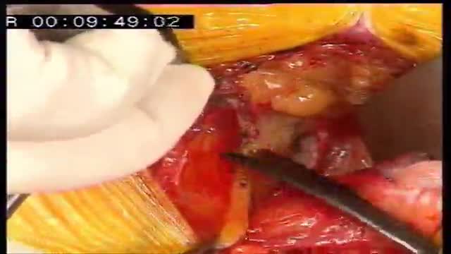 Minimal invasive anterior preperitoneal inguinal hernia repair