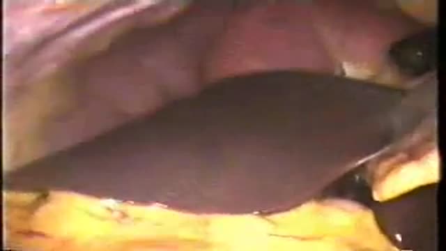 Cholecystectomy AMAZING video