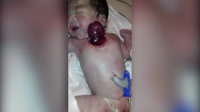 ⁣Baby Is Born With Heart Outside Chest!