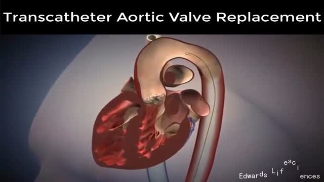 ⁣Transcatheter aortic valve replacement (TAVR)
