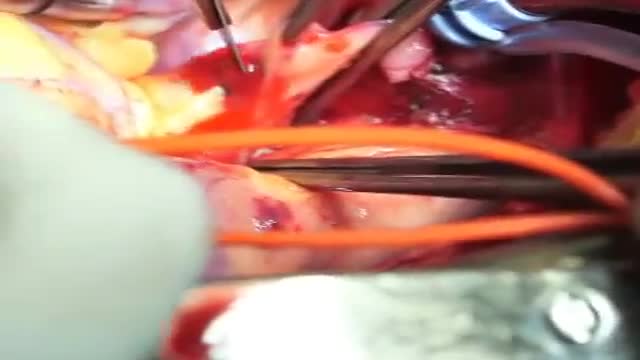 ⁣Surgical repair of a coexisting ruptured sinus of valsalva