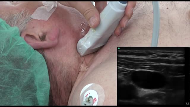 ⁣Ultrasound-guided internal jugular cannulation