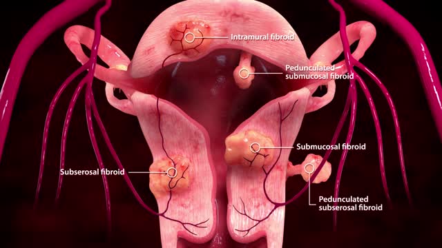 Uterine Fibroid Embolization Treatment