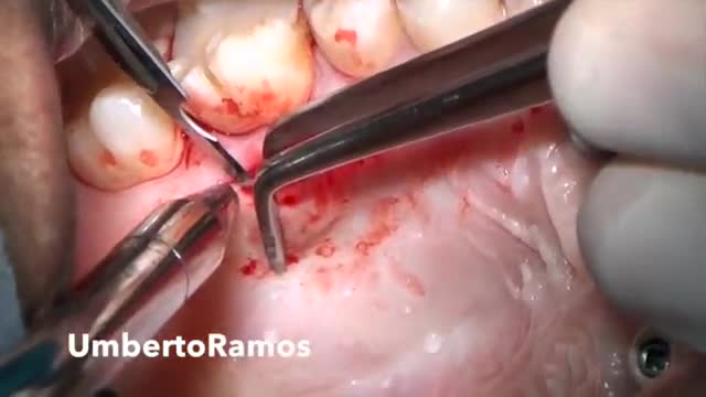 ⁣Connective tissue graft from the Palate