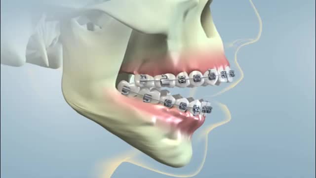 Orthognathic Surgery For A Severe Overbite