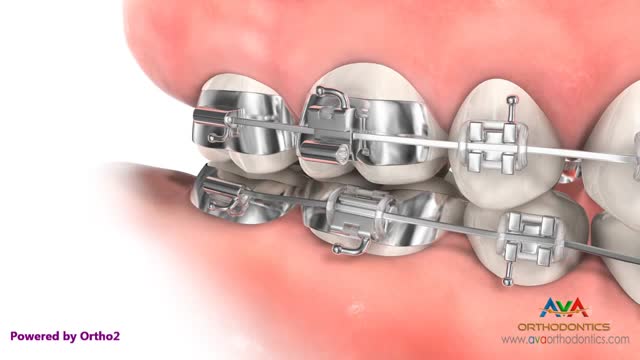 ⁣Orthodontic Device