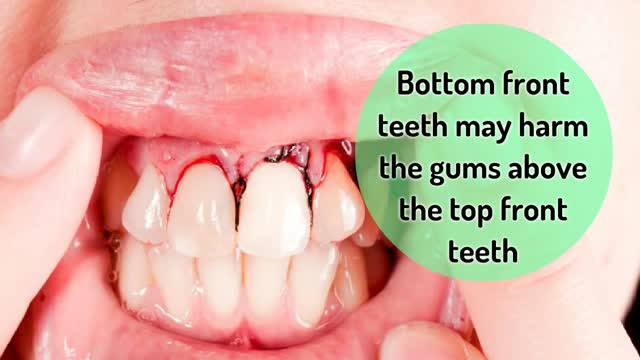 The Importance of Correcting your Overbite