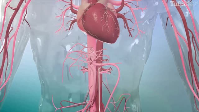 Surgical Procedure for Hypertrophic Cardiomyopathy (HCM)