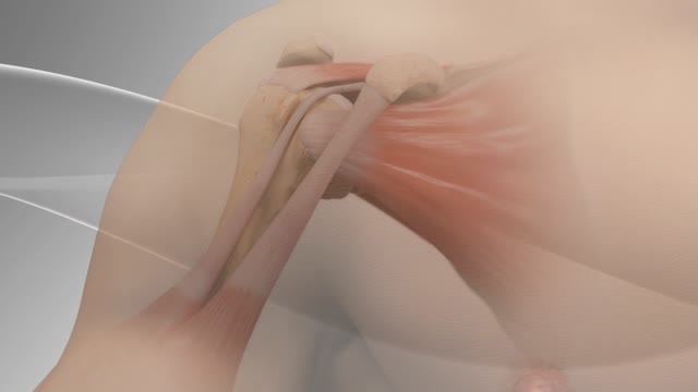 ⁣Biceps Tenodesis