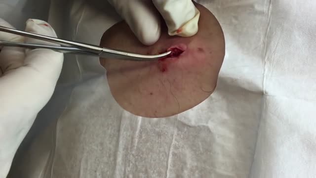 Removal of Epidermal Cyst