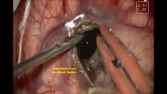 CAVERNOUS ANGIOMA BRAIN