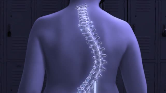 ⁣Treating Scoliosis with Magnets