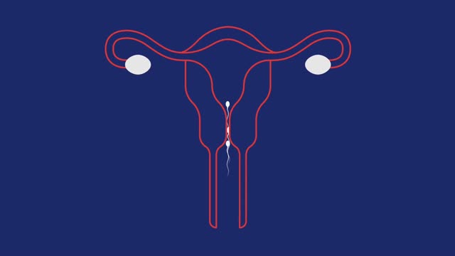 ⁣How Does an IUD Work as Birth Control
