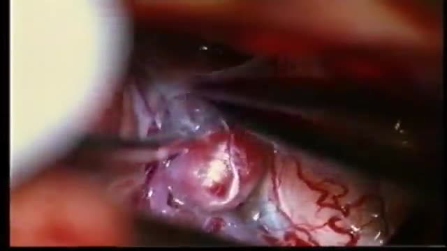 ⁣MICROSURGICAL CLIPPING OF CEREBRAL ANEURYSM