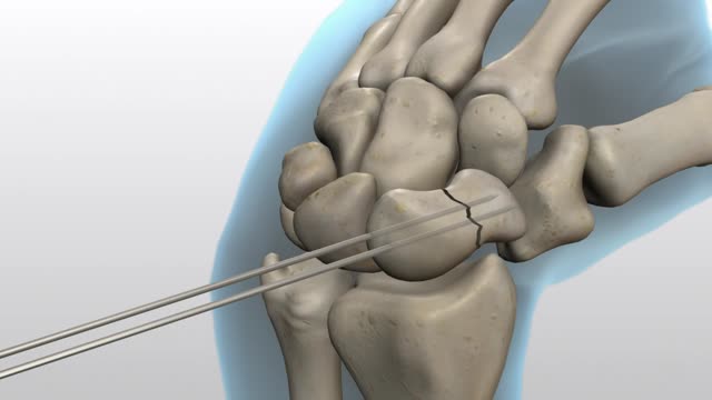 Scaphoid Hand Fracture Management