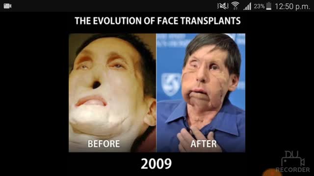 The Face Transplant is getting better